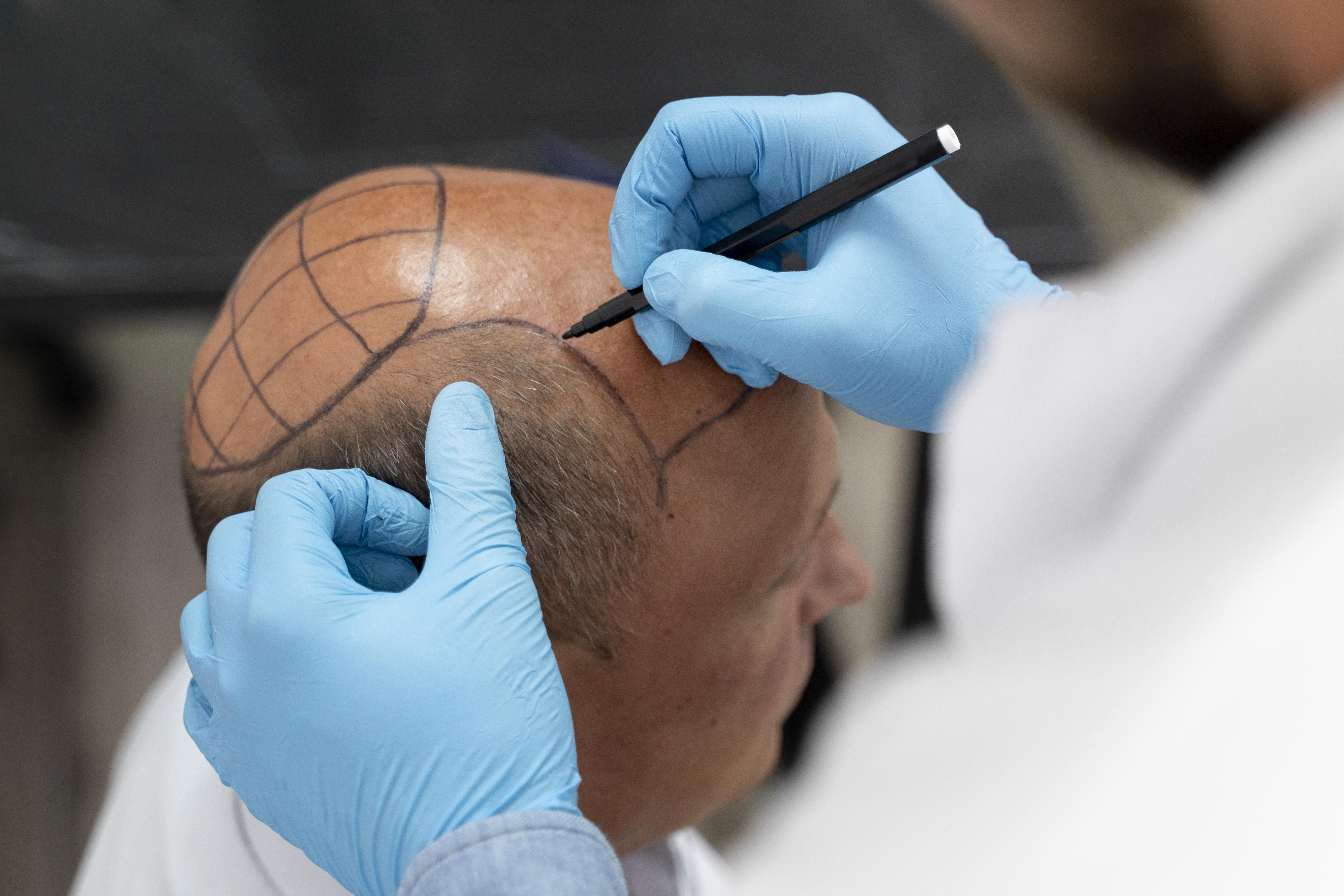 Hair transplants in calicut