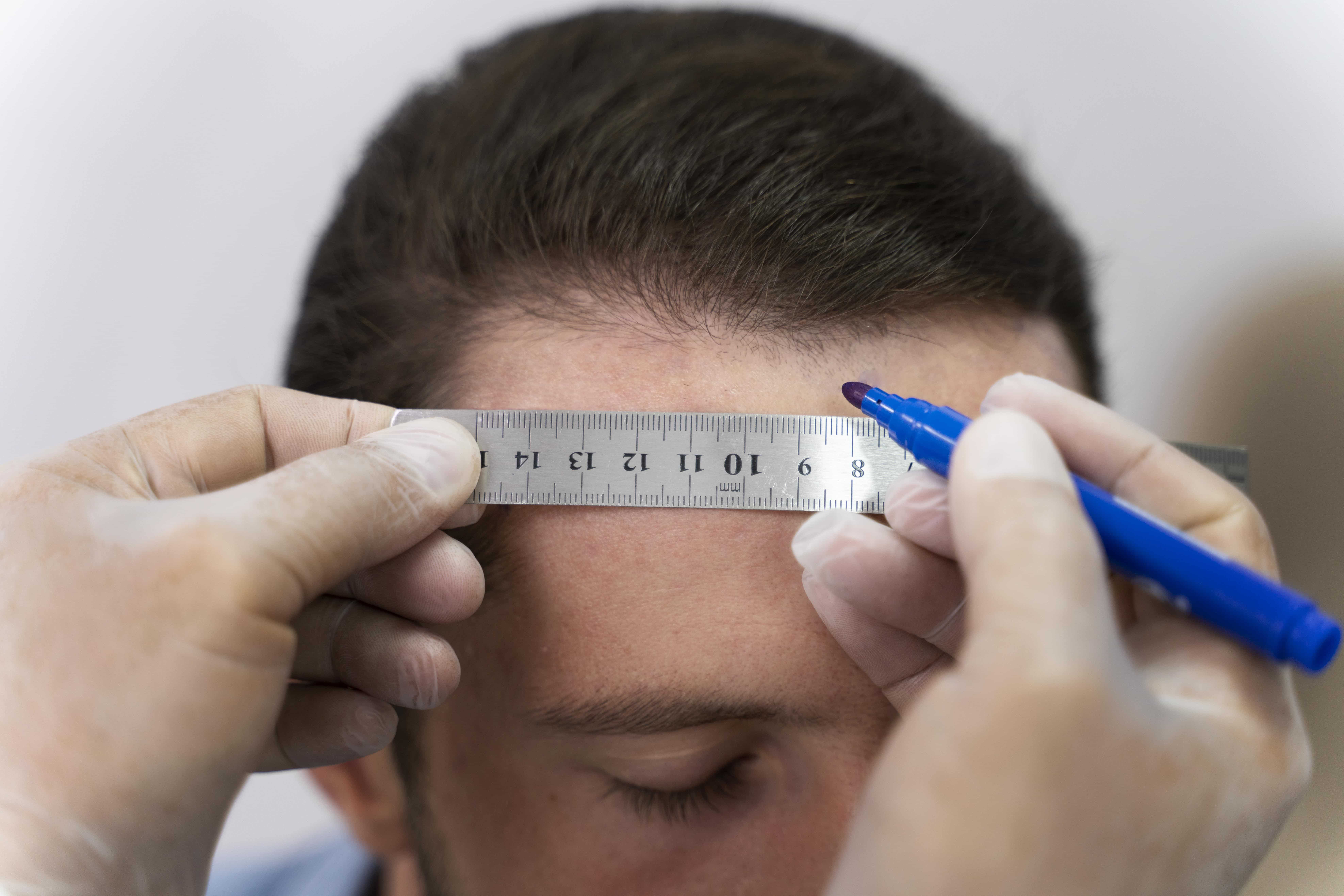 Hair transplantation in Kochi