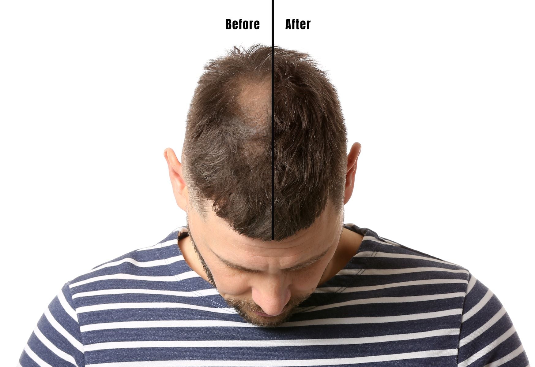 Hair loss treatment