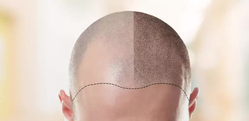 Hair loss treatment
