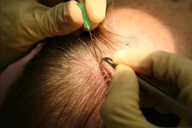 Hair loss treatment