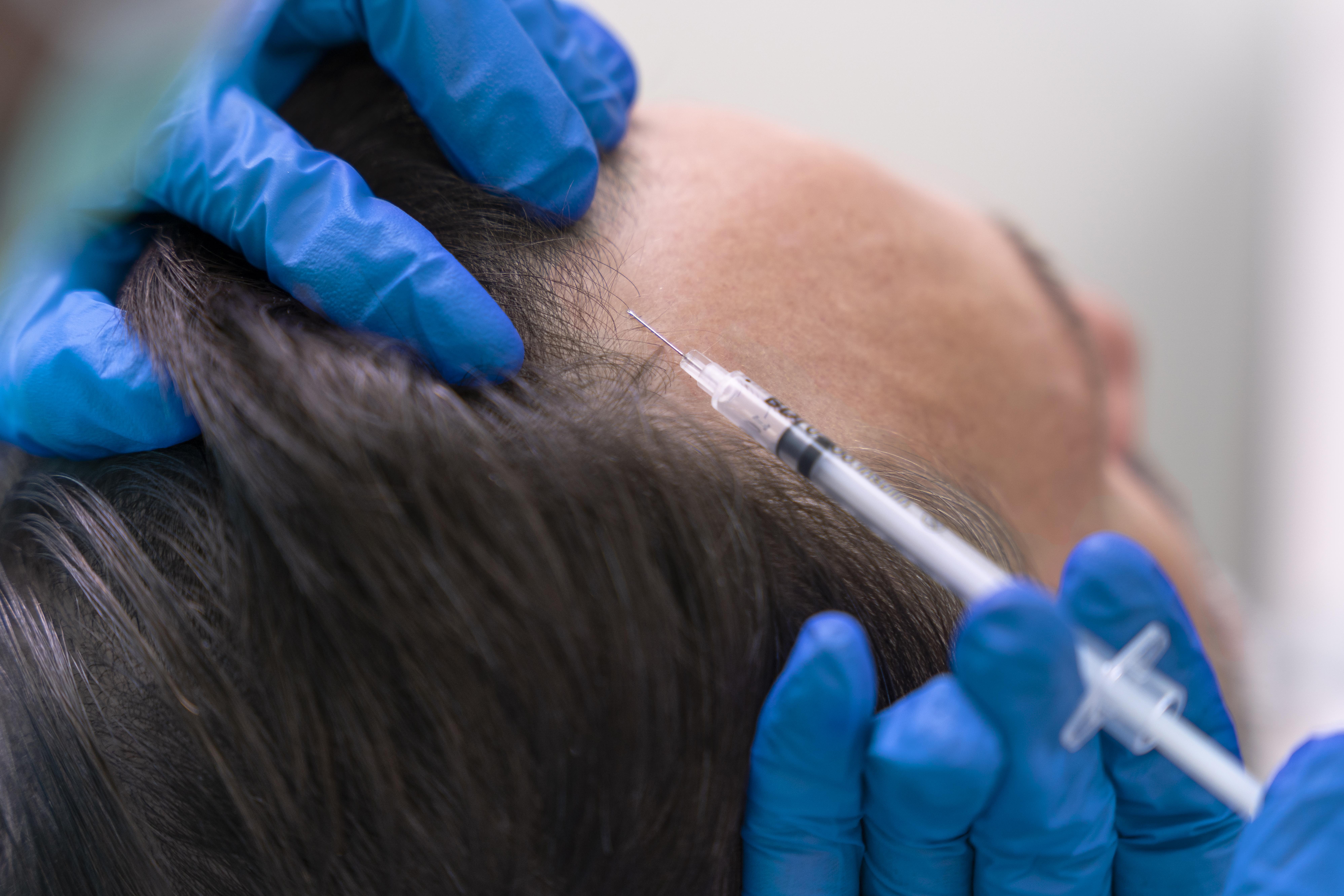 Hair loss treatment