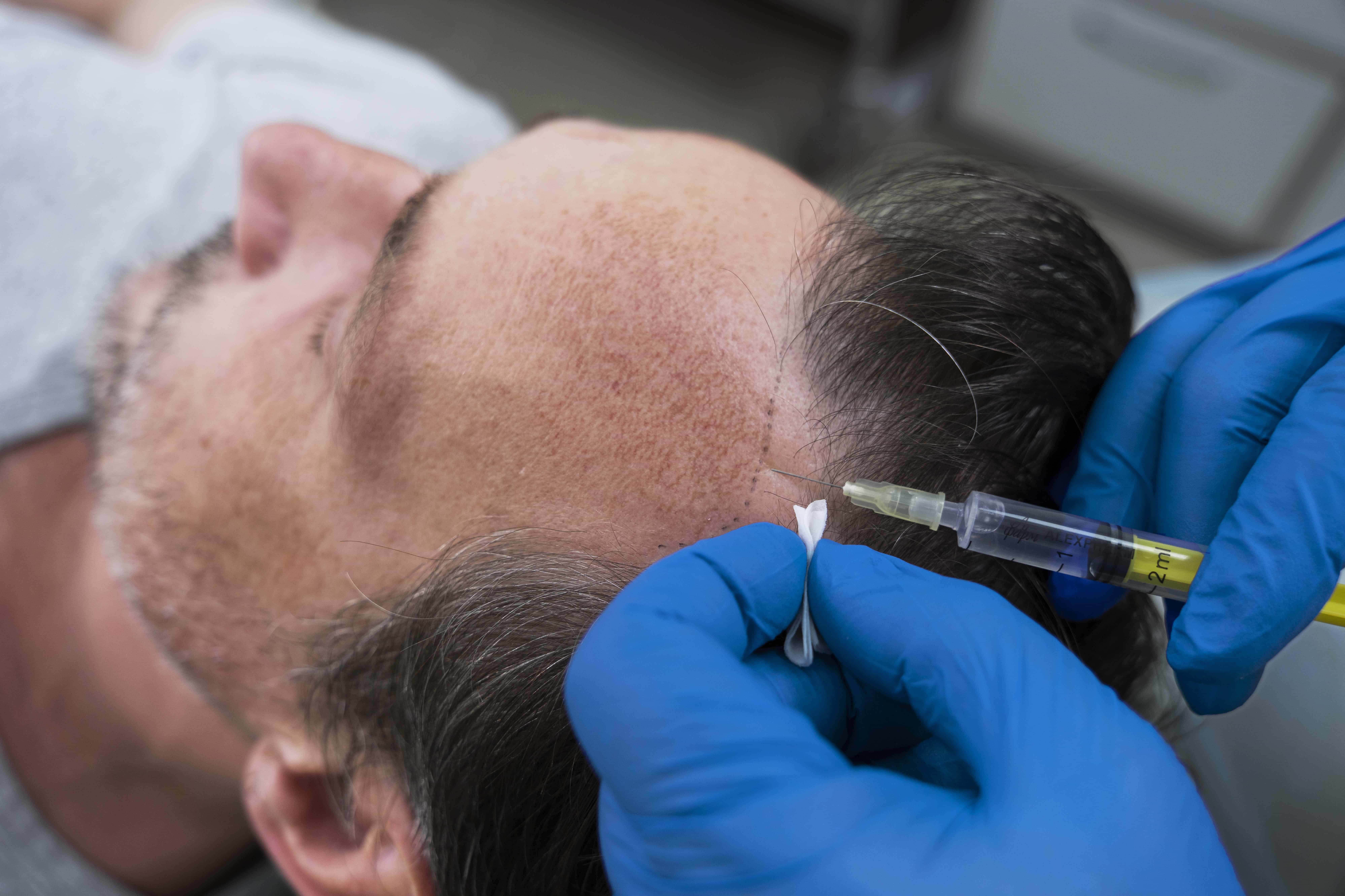 Hair transplantation cost in Kochi