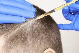 FUE Hair Transplant Cost In Kochi 