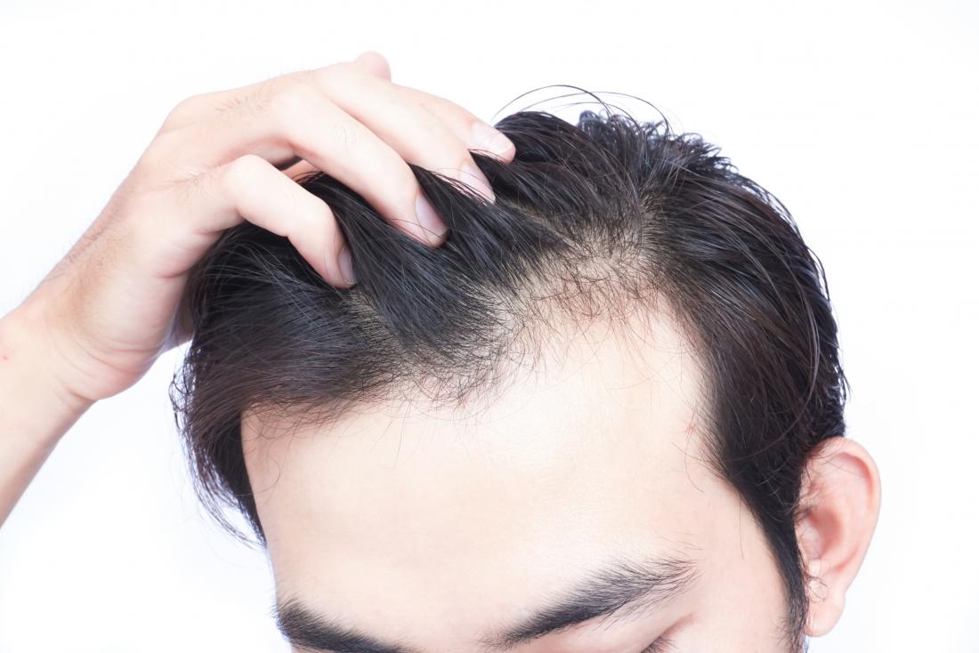 Hair loss treatment