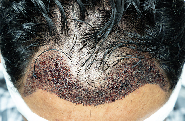 best hair transplantation in Kerala
