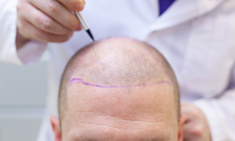 Hair transplantation
